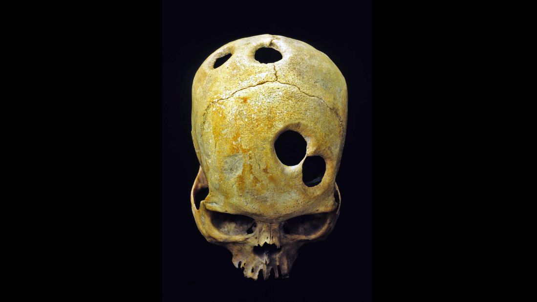 An ancient surgeon in Peru probably used a sharp tool to carefully groove the perfect circles in this Incan skull. Healed bone around the edge of the holes indicates the patient was alive during the surgery and probably survived. Scholars can't explain the purpose behind the mysterious multiple openings. 