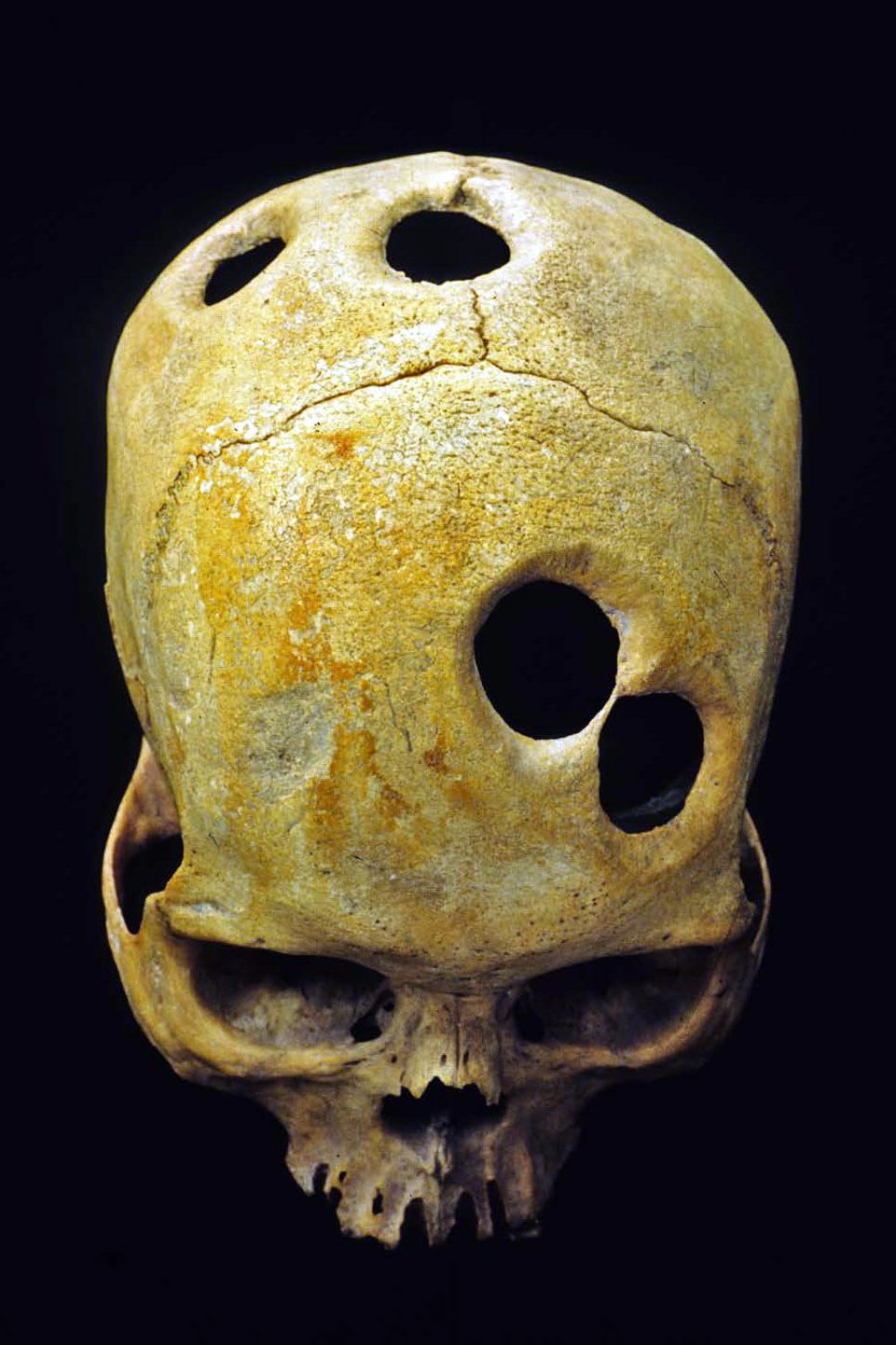Were mystery holes in skulls an ancient aspirin? | CNN