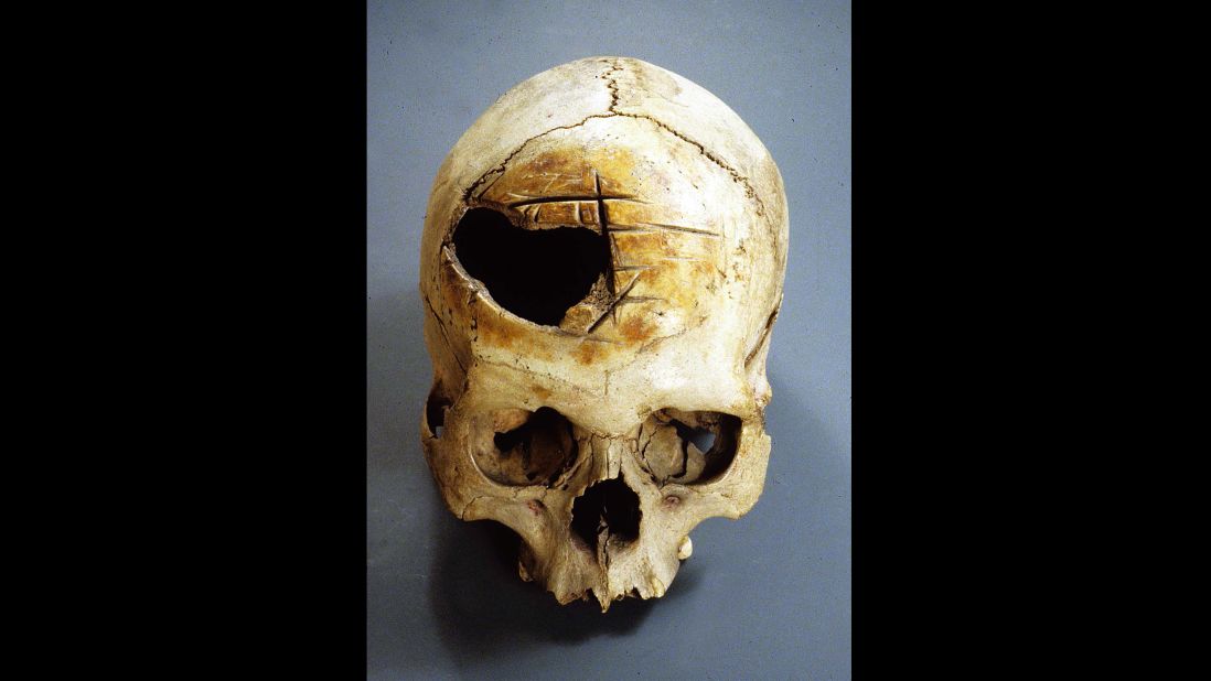 The deep, straight cuts in this Peruvian skull were made by rocking a blade back and forth. Their varying placement suggests the surgery was poorly executed and unsuccessful. 
