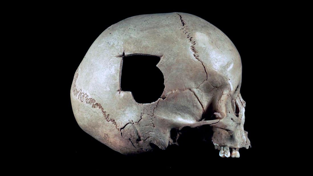 The half-circle broken out of this Peruvian skull was possibly caused by a slingshot stone. A triangular surgical hole extends from the fracture. 