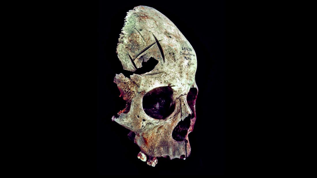 A surgical hole in this skull was started and then stopped. The linear criss-cross cuts are unfinished, perhaps because the patient, a Peruvian child, didn't live long enough for the surgery to be completed. A smashed and broken section of injured bone is visible inside the attempted opening. 