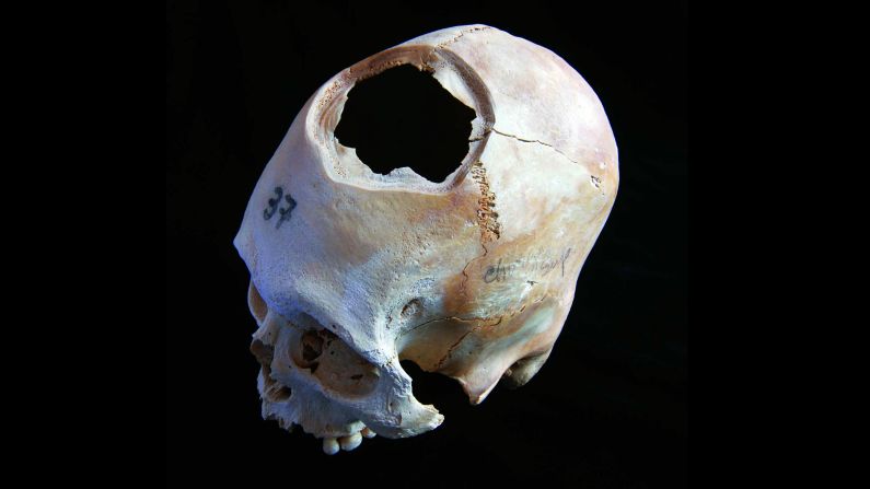 This skull is another example of early cranial surgery in Peru. Long-term survival rates were only 40%. Fewer than half the patients made it. 