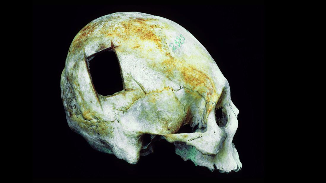 Rectangular holes like the one in this Peruvian skull could be made rapidly by rocking a sharp tool down through the bone. The method was faster and riskier than scraping or grooving a hole, since it increased the chances of tearing directly into the brain with the blade. 