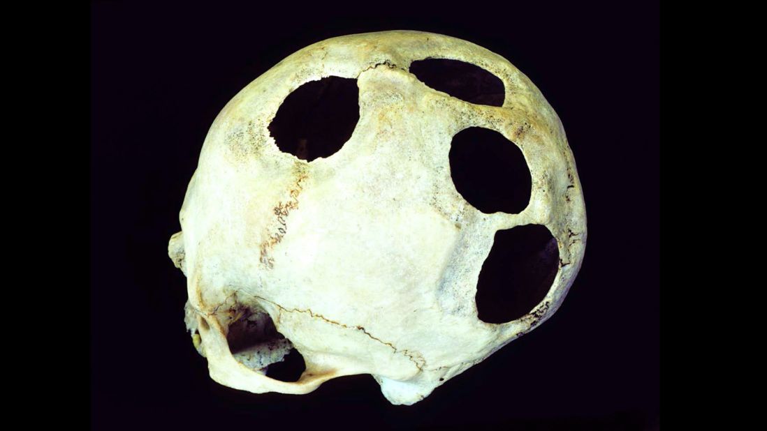 It's unlikely this Incan patient had four head injuries, each requiring surgery. The hole is another example of unexplained multiple openings. Survival rates for prehistoric cranial surgery in Peru greatly improved over the course of two millennia. In Incan times, 500 to 700 years ago, nearly 80% of patients survived. 
