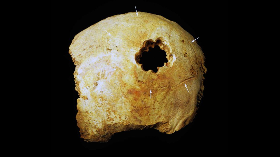 The hole in this skull was made by drilling a circle of smaller holes and then cutting away the bone between them. Of the four techniques used by Peru's ancient surgeons, it's the most similar to modern surgery. Today, to create a hole, often surgeons drill four smaller holes in a rectangle and then saw away the bone between them. 