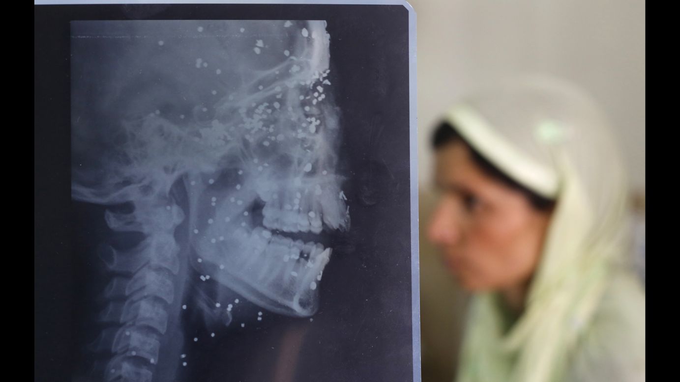 An X-ray sheet shows pellet injuries on 14-year-old Insha Malik as a relative sits by her hospital bed in Srinagar, India, on Wednesday, July 20. Insha was hit by pellets while watching a protest. Dozens of people were killed and hundreds were injured after protests erupted in the disputed region of Kashmir earlier this month.