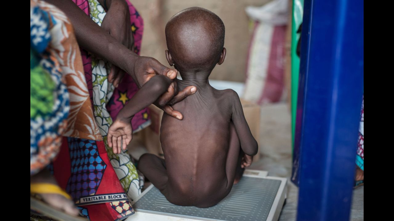 A young girl suffering from severe acute malnutrition getting weighed at a clinic on the outskirts of Maiduguri, in northeastern Nigeria.   