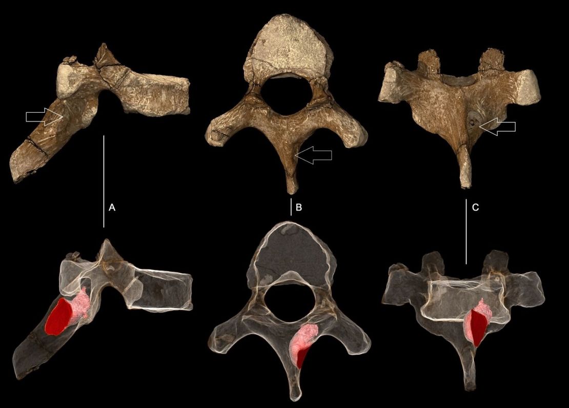 An ancient vertebra, with the outline of the tumor rendered in pink. 