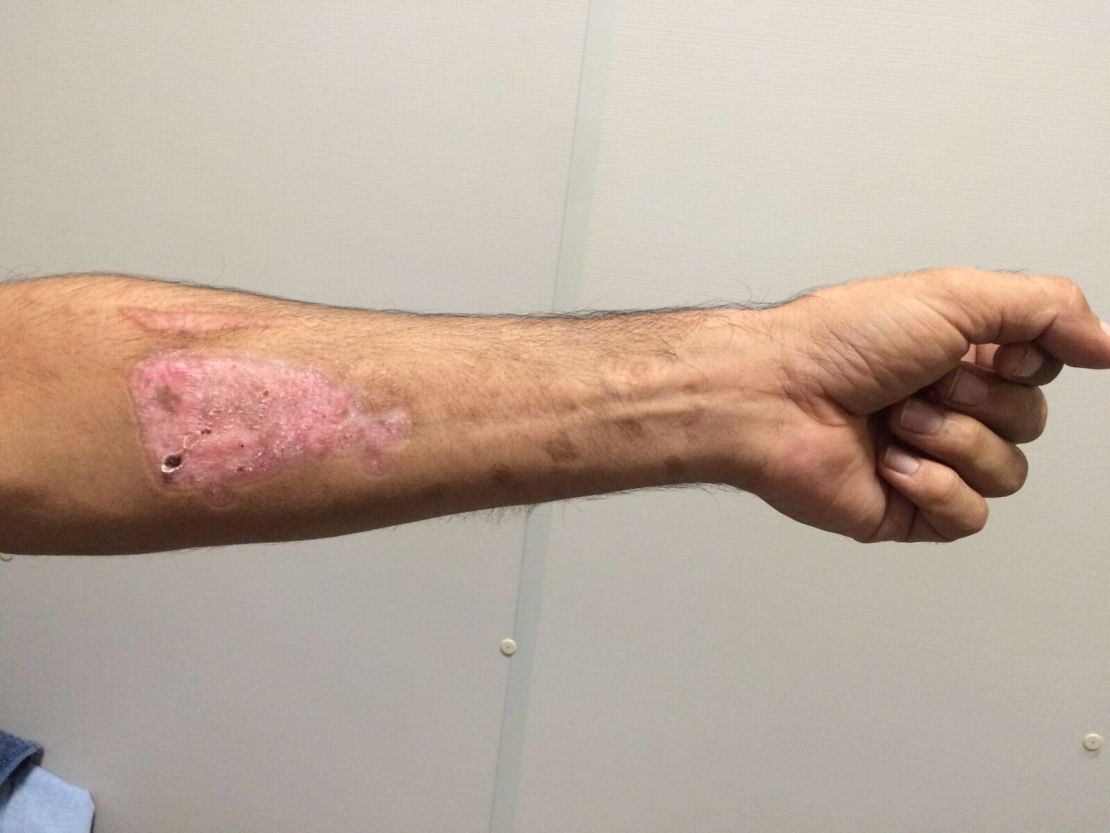 A refugee on Nauru shows a self inflicted injury in July.