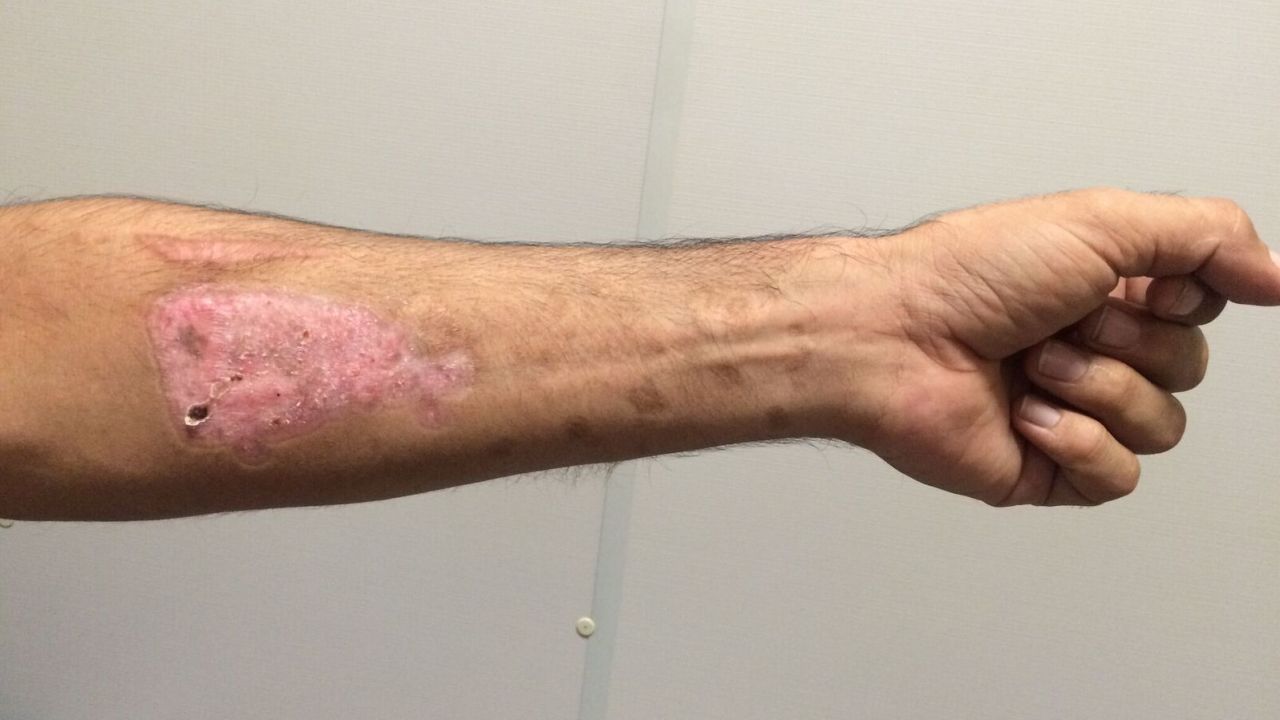 A refugee on Nauru shows a self inflicted injury in July.