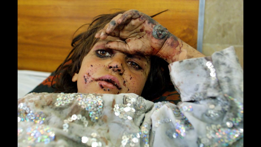 <strong>2001: Quetta, Pakistan </strong>-- Seven-year-old Fermina Bibi, from Kandahar, Afghanistan, lies wounded in a hospital bed. She and her brother were injured when their home in Kandahar was bombed. They were transported to Pakistan for treatment. 