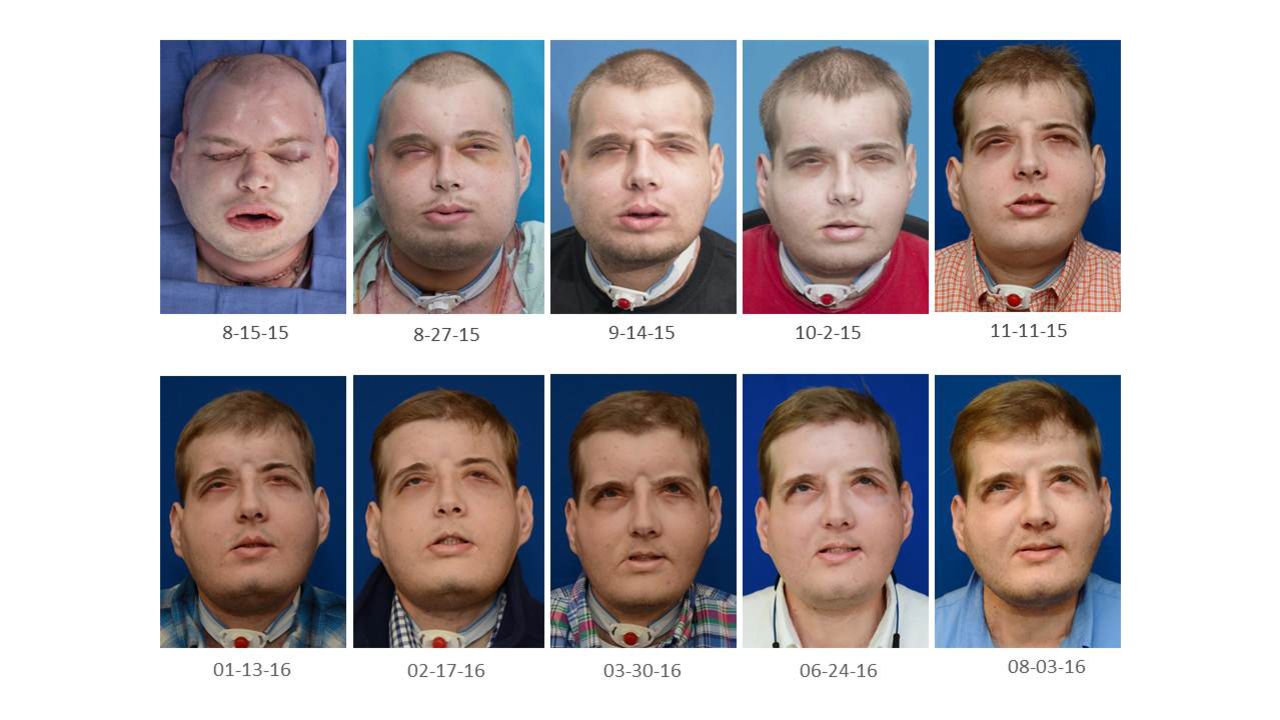 Firefighter and face transplant recipient Patrick Hardison's face has recovered with no rejection episodes.