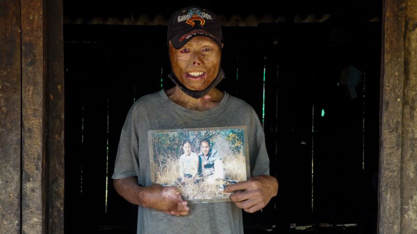Yei Yang holds a picture of him and his wife before he was seriously injured by an unexploded bomb dropped during America's secret war in Laos.
