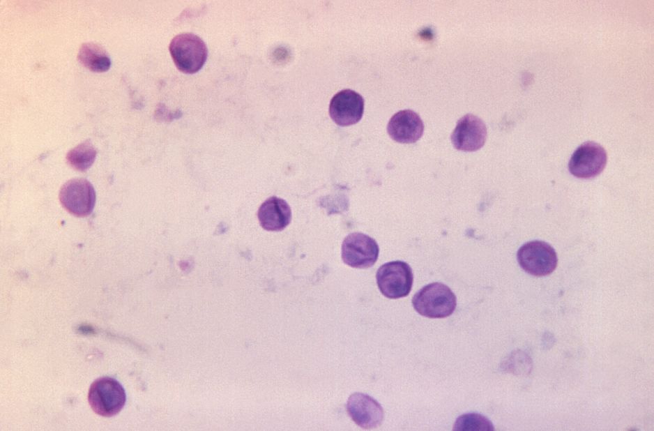 The fungus <a href="https://www.cdc.gov/fungal/diseases/pneumocystis-pneumonia/" target="_blank" target="_blank"><em>Pnuemocystis jirovecii</em></a> can also cause severe infections, particularly in people with HIV/AIDS. It caused one of the main AIDS-defining illnesses in the United States after the epidemic started in the 1980s.
