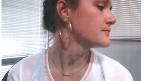 Delaney Robinson's attorney provided this photo purportedly taken on the night of the attack showing what the lawyer said was bruising on Robinson's neck. 