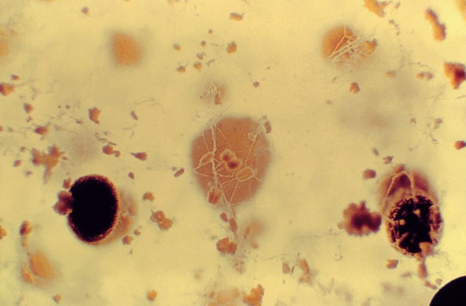 One such fungus is <a href="https://www.cdc.gov/fungal/diseases/aspergillosis/" target="_blank" target="_blank"><em>Aspergillus</em></a><em> -- </em>a common mold found both indoors and outdoors. Most of us breathe in its spores everyday without getting sick, but for those with weakened immune systems it can cause serious lung infections and allergic reactions.