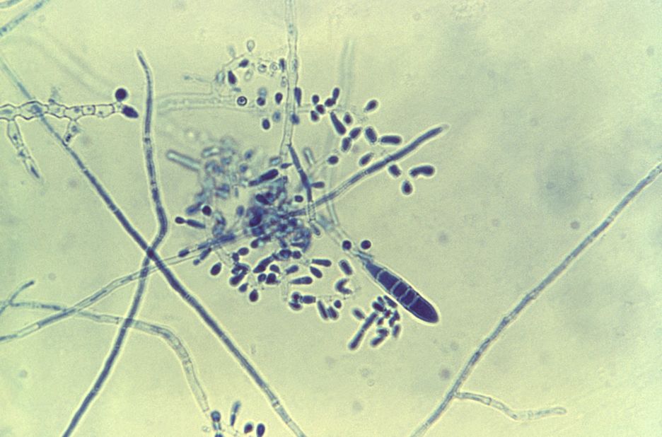 While deadly fungal infections kill over a million people every year, superficial ones such as <a href="http://www.cdc.gov/fungal/diseases/ringworm/" target="_blank" target="_blank">ringworm</a> (pictured), athlete's foot and dandruff can affect 1-2 billion people annually, as well as put stress on health care systems.