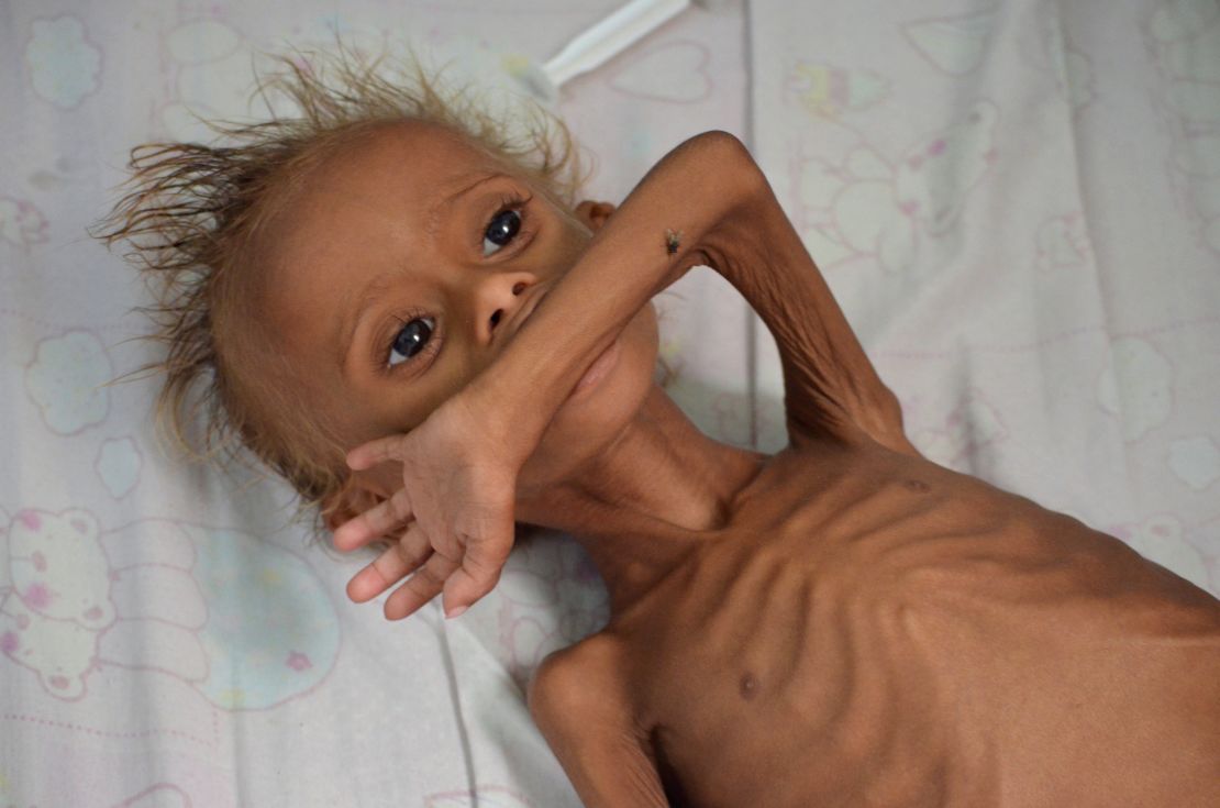 A malnourished boy lies on a bed at a hospital in the Red Sea port city of Houdieda, Yemen, in  September 2016.