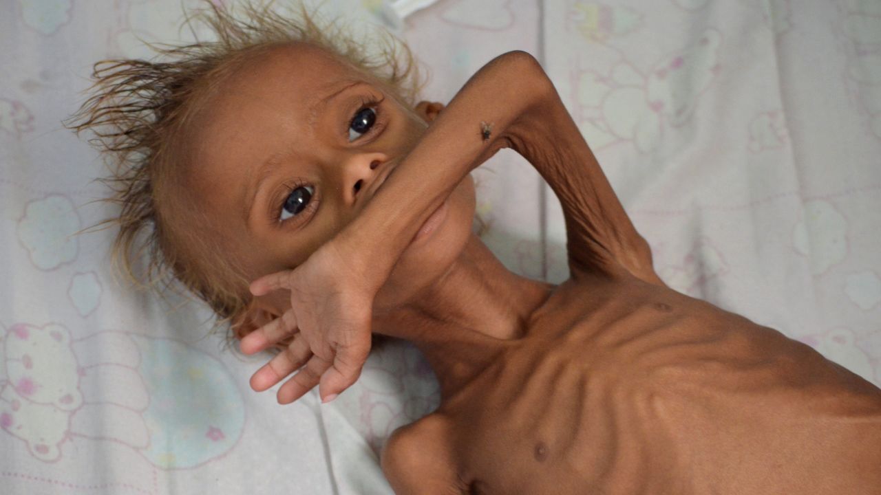 A malnourished boy lies on a bed at a hospital in the Red Sea port city of Houdieda, Yemen, in  September 2016.