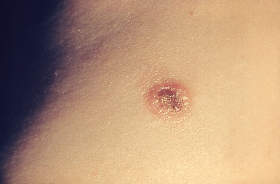 There are over 30 different species of <em>Cryptococcus</em> -- here's an example of a <a href="https://phil.cdc.gov/phil/details.asp" target="_blank" target="_blank">skin lesion</a> caused by the fungus.