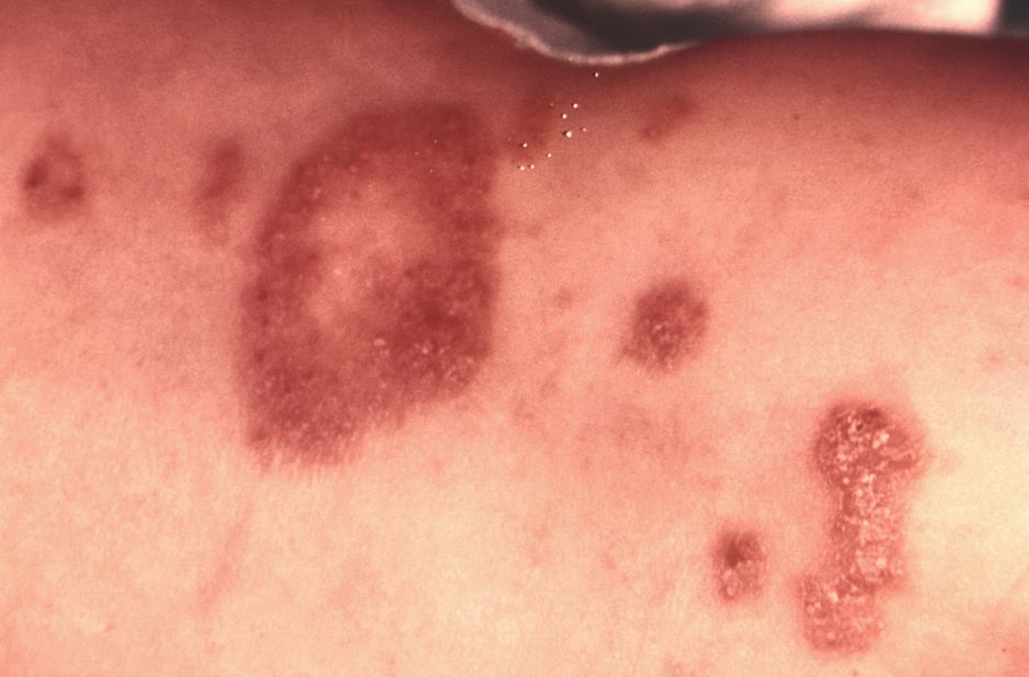 This is an example of a patient who got a <a href="https://phil.cdc.gov/phil/details.asp" target="_blank" target="_blank">ringworm infection</a> on their torso, caused by <em>Trichophyton verrucosum</em> -- a fungal organism commonly associated with horses and cattle.
