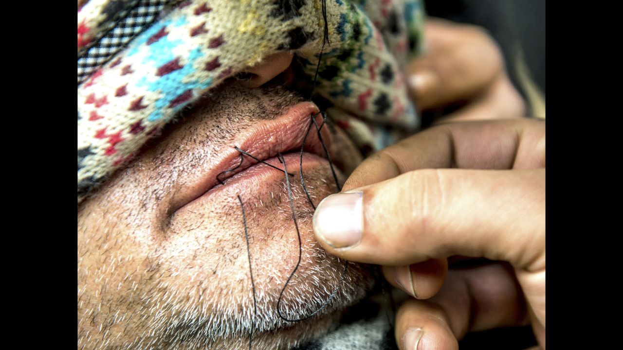 A man sews the lips of an Iranian migrant at the camp on Thursday, March 3. Journalists said at least nine Iranians stitched their mouths shut and went on a hunger strike to protest the camp's dismantling.