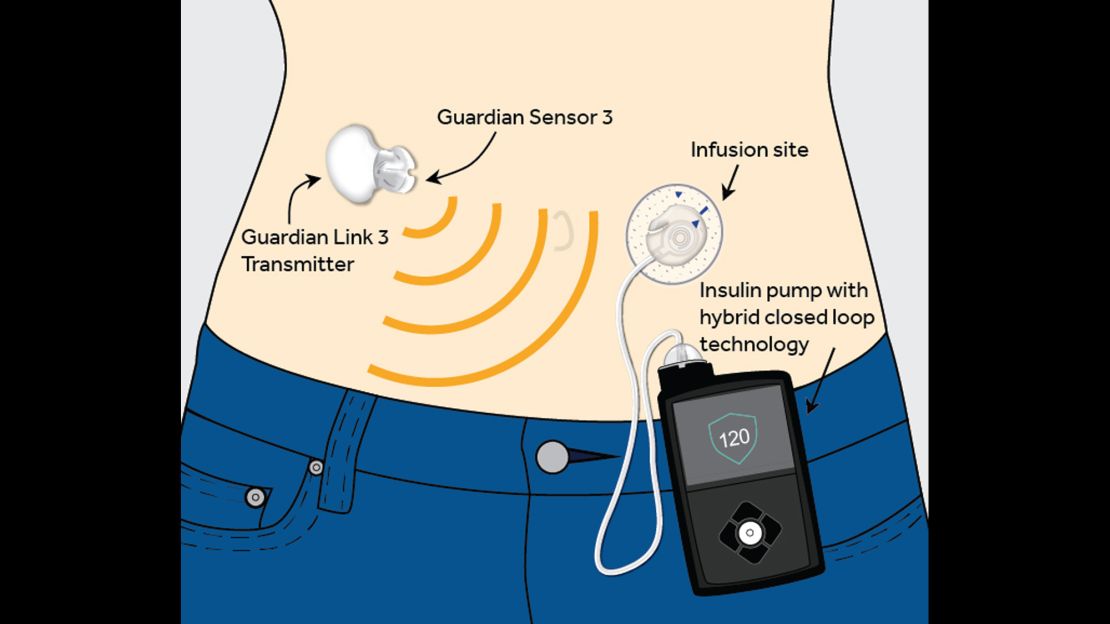 The Medtronic MiniMed 670G system