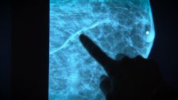 Mammograms can help determine risk for Heart Disease_00004615.jpg