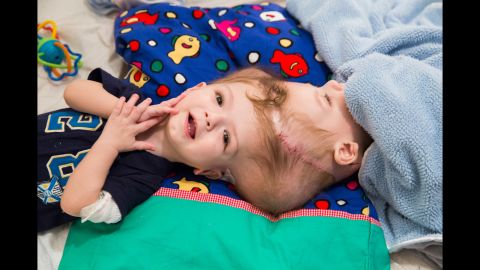 <strong>October 5:</strong> Anias and Jadon McDonald, twins who were born conjoined at the head in September 2015, are seen eight days before <a href="http://www.cnn.com/2016/11/08/health/conjoined-twins-surgical-team/" target="_blank">they were surgically separated</a> at a New York hospital. The procedure, known as craniopagus surgery, is so rare that it has been conducted only 59 times since 1952. CNN was allowed <a href="http://www.cnn.com/2016/10/14/health/conjoined-twins-separation-surgery/index.html" target="_blank">exclusive access</a> to the surgery and the McDonald family.