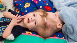 Anias stares into the camera. His gaze is so captivating, his mother says, "it's like he looks at your soul. ... He's just a silent warrior. He's sweet and strong." Only 1 out of every 2.5 million live births results in twins conjoined at the head.