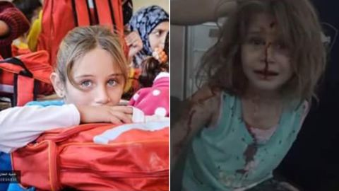 Two images show an 8-year-old Syrian girl before and after an airstrike hit her town last year.