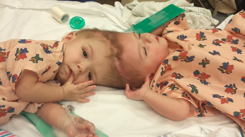 Conjoined Twins Separated, Both Out Of Surgery | CNN