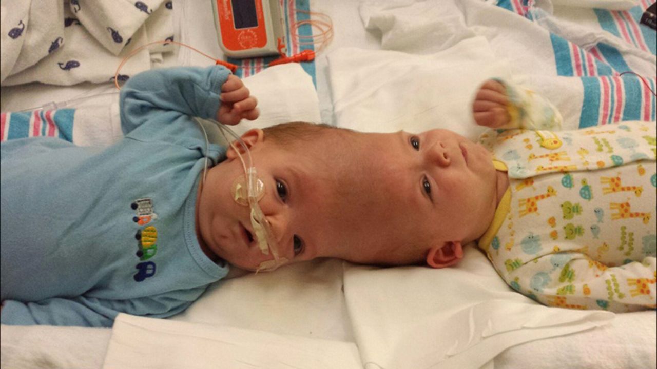 Anias and Jadon McDonald were born conjoined at the head on September 9, 2015, via an unscheduled C-section. "They were normal little boys, like any other two little babies you would see," said their father Christian McDonald, "except for being conjoined."