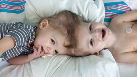 Nicole McDonald says she and her conjoined twins, Anias and Jadon, are "in the final lap of this part of the journey."