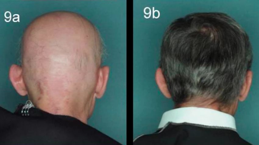 experimental drugs restore hair loss 