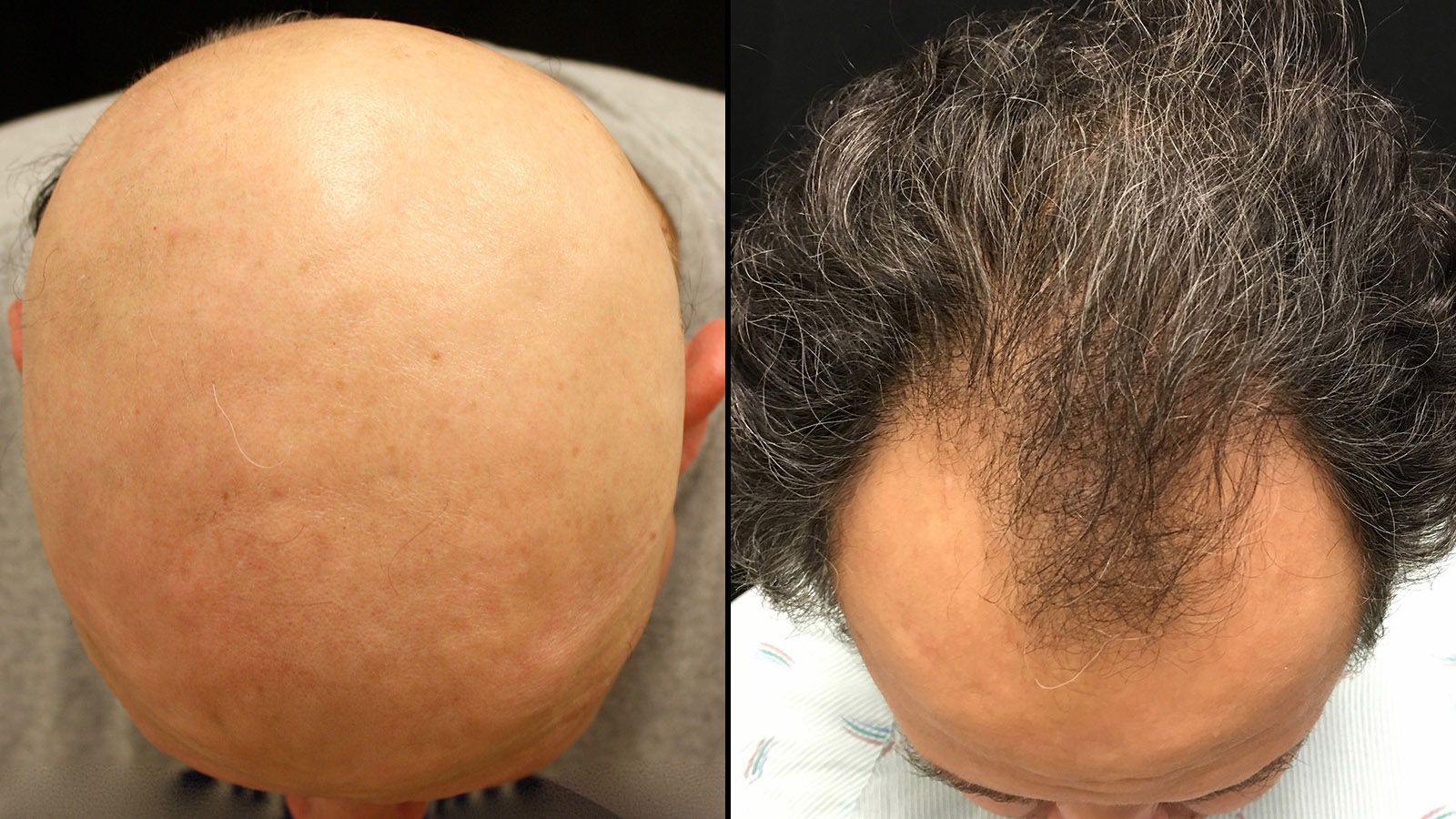 Drug reverses one baldness type; is male pattern next? | CNN