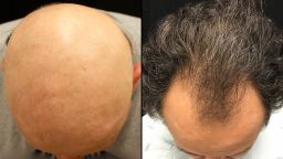 Experimental drugs restore hair loss SPLIT