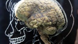BRISTOL, UNITED KINGDOM - MARCH 10:  A real human brain being displayed as part of new exhibition at the @Bristol attraction is seen on March 8, 2011 in Bristol, England. The Real Brain exhibit - which comes with full consent from a anonymous donor and needed full consent from the Human Tissue Authority - is suspended in large tank engraved with a full scale skeleton on one side and a diagram of the central nervous system on the other and is a key feature of the All About Us exhibition opening this week.  (Photo by Matt Cardy/Getty Images)