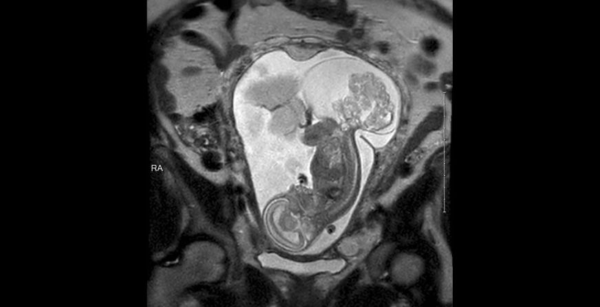 The tumor threatening LynLee's life can be seen in this ultrasound. Sacrococcygeal Teratoma is found more often in girls than boys. 