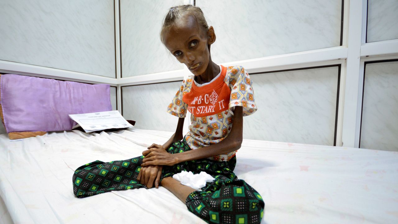 Severely malnourished, Saida Ahmad Baghili, 18, sits on a bed at a hospital in Hodeida, Yemen.