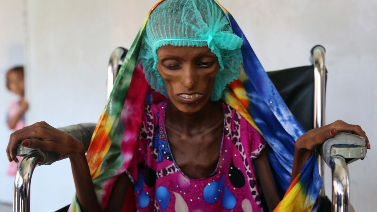 Baghili is being treated for severe malnutrition at al-Thawra hospital in Hodeida.