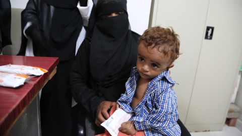 A 3-year-old is treated in Hajjah. In some areas, malnutrition among children under 5 is at a high.