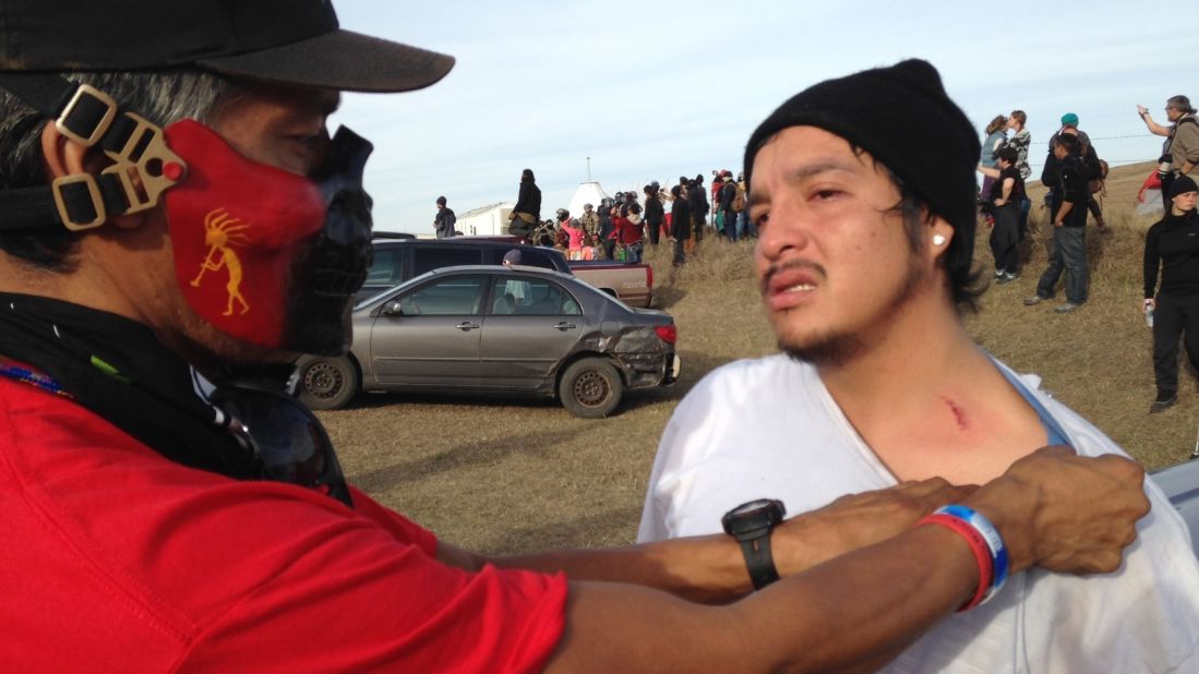 A protester shows where he was hit by a bean-bag round fired by officers trying to force protesters off the private land.