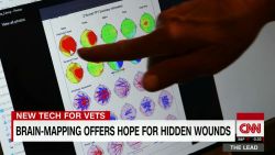 new technology veterans brain mapping lead tapper dnt_00004304.jpg