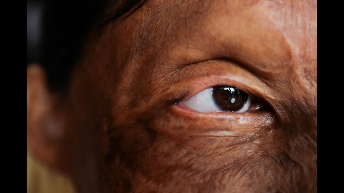 A close-up of Rupa's eye. According to the Acid Survivors Foundation in India, acid attacks result from a number of situations: family disputes, vengefulness, jealousy, mistaken identity and sex crimes, among others. There were 249 reported acid attacks last year in India, the foundation said.