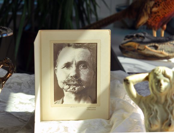 Jean-Bernard Gillot owns Librairie Alain Brieux, a shop in Paris where he sells books and medical curiosities. He has a special interest in early medical photography, like this photo of a 1905 chin reconstruction. 