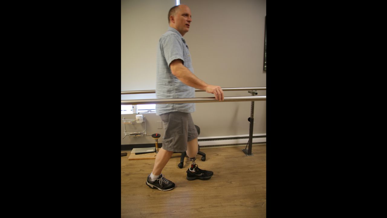 Jim Ewing takes his first steps after his amputation.