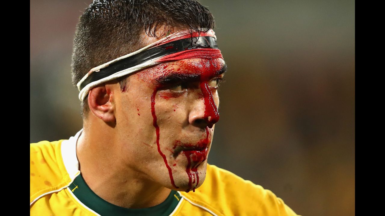 Australian rugby player Rory Arnold bleeds from his head Saturday, June 18, during a Test match against England in Melbourne.