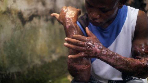 This 26-year-old man says he had acid sprayed on him on Biafra Remembrance Day in Onitsha.