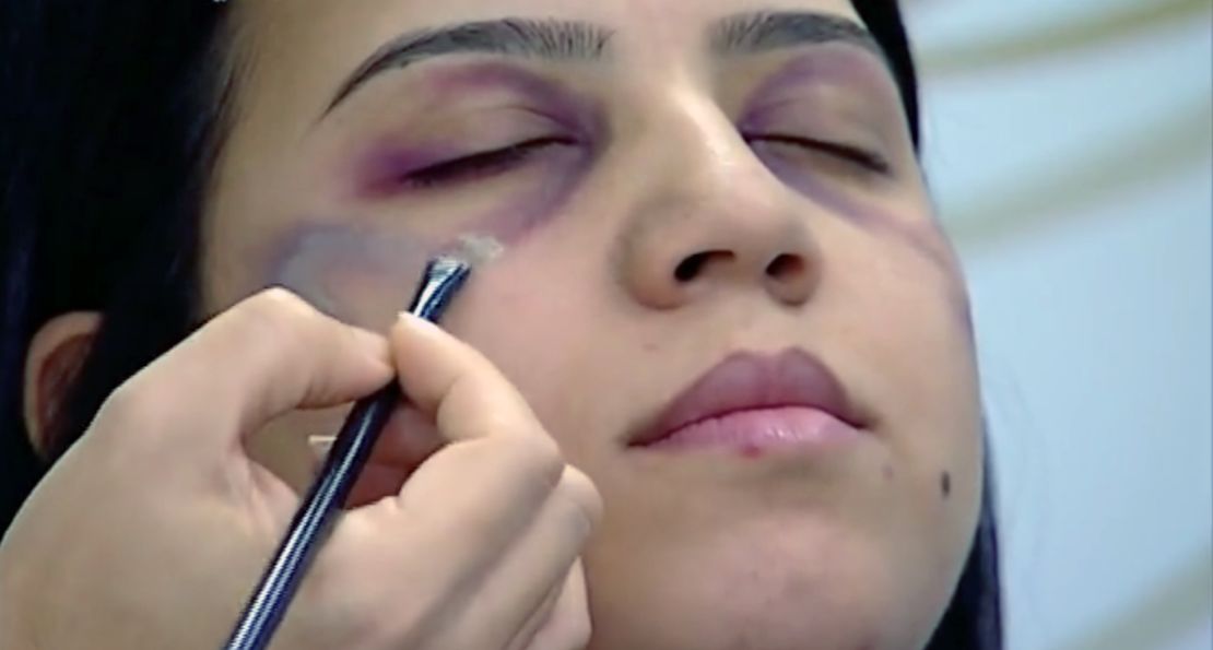 The makeup artist showed how to cover  facial bruising with concealer.
